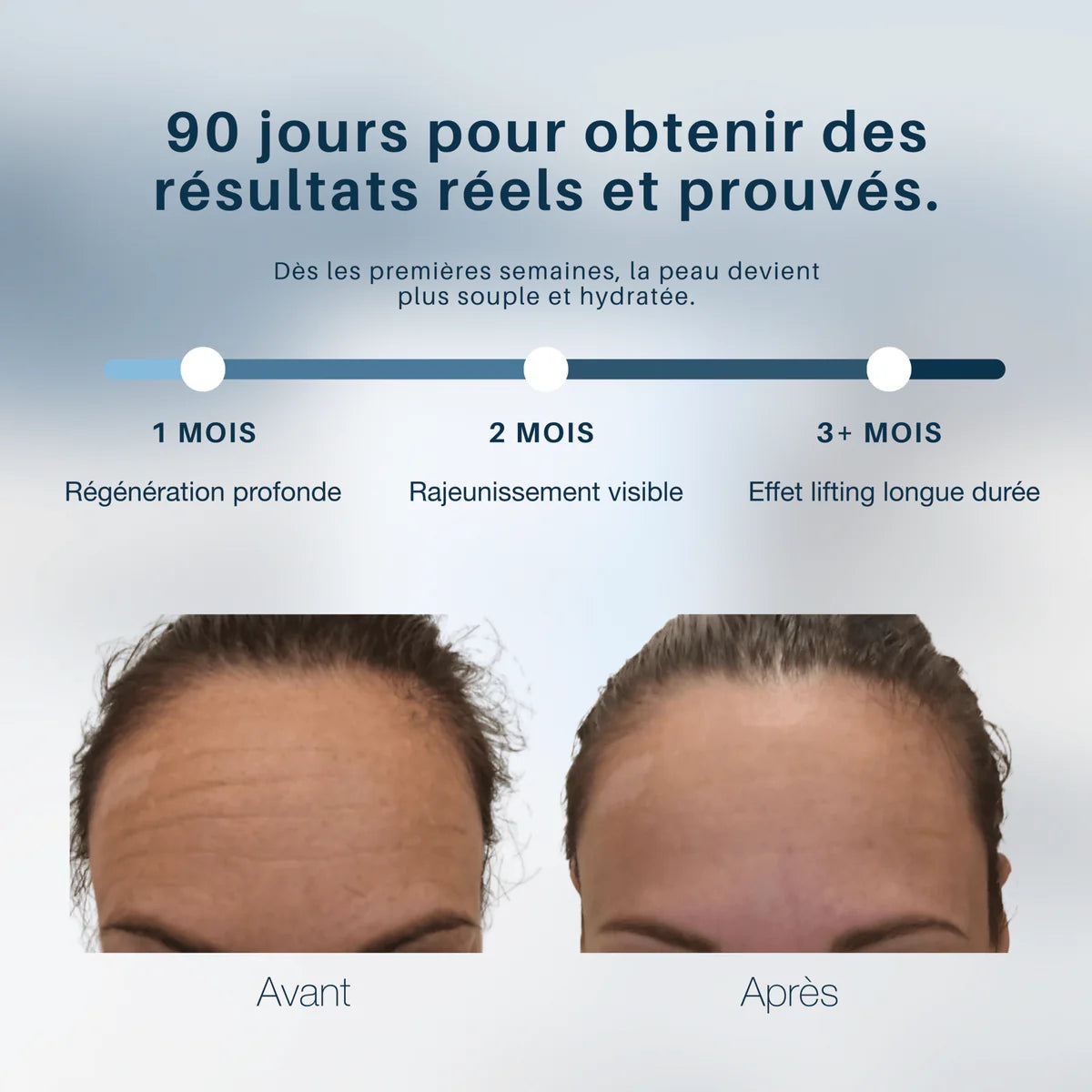 Mycollagénlift